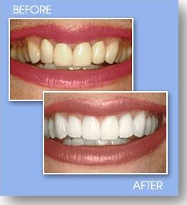 Teeth Whitening Service Photo 1