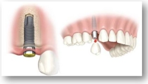 Implant Dentistry Services Photo 1